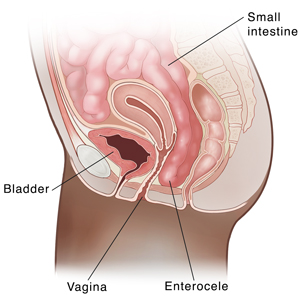 Side view cross section of female pelvis showing prolapsed small intestine (enterocele).