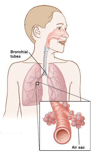 Illustration showing the position of the lungs and bronchial tubes, with a close up view of an air sac.