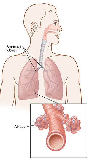 Front view of man's chest showing lungs and bronchial tubes, with a close up view of an air sac.